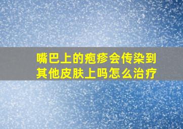 嘴巴上的疱疹会传染到其他皮肤上吗怎么治疗