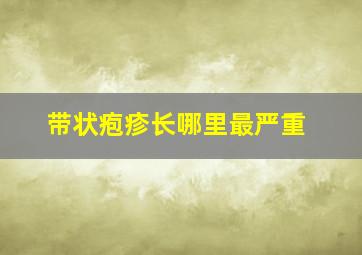 带状疱疹长哪里最严重