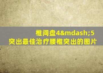 椎间盘4—5突出最佳治疗腰椎突出的图片