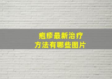 疱疹最新治疗方法有哪些图片