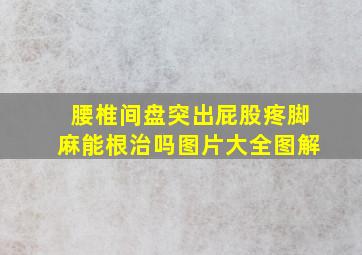 腰椎间盘突出屁股疼脚麻能根治吗图片大全图解