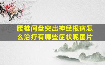 腰椎间盘突出神经根病怎么治疗有哪些症状呢图片