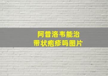 阿昔洛韦能治带状疱疹吗图片